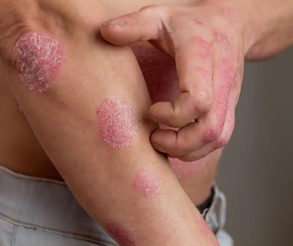 5 bệnh nấm da thường gặp và cách điều trị bệnh hiệu quả