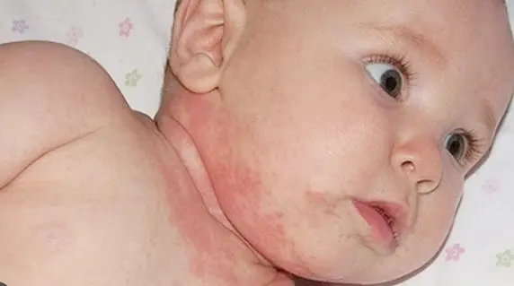 5 cách chữa bệnh chàm eczema ở trẻ em