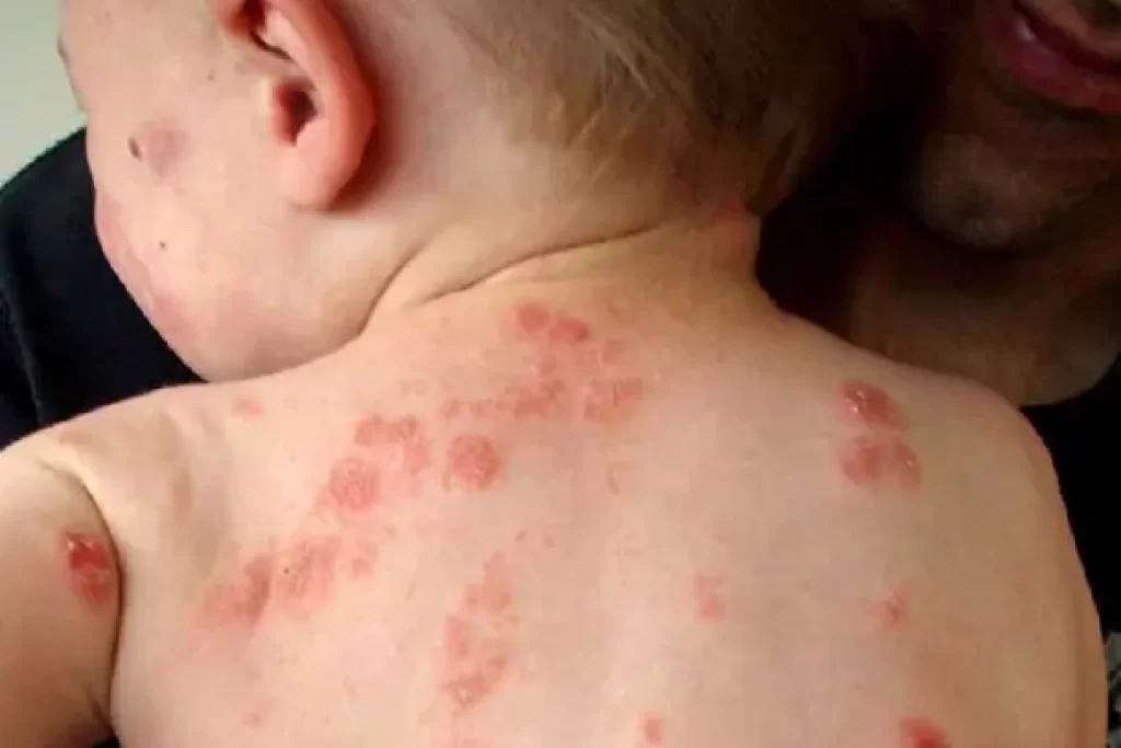 bệnh chàm-eczema ở trẻ em