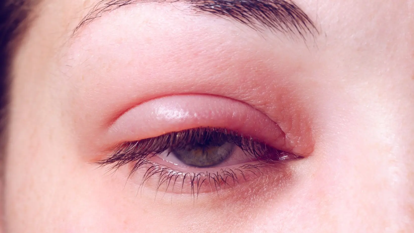 Bệnh đau mắt đỏ kéo dài bao lâu